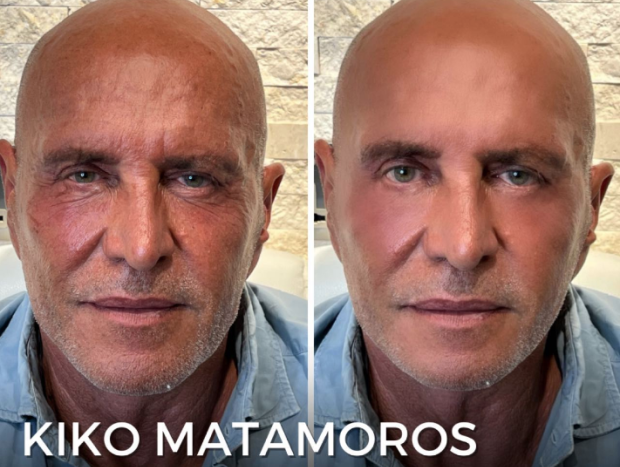 kiko matamoros último retoque estético 1