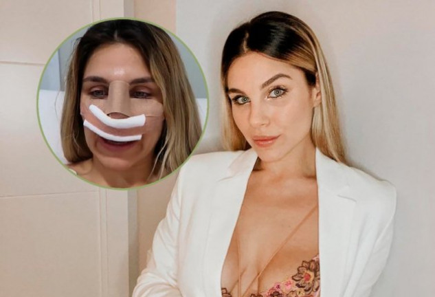 Ivana Icardi ha compartido en redes sociales y en MtMad el proceso de su rinoplastia.