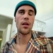 Justin Bieber con una parálisis facial.