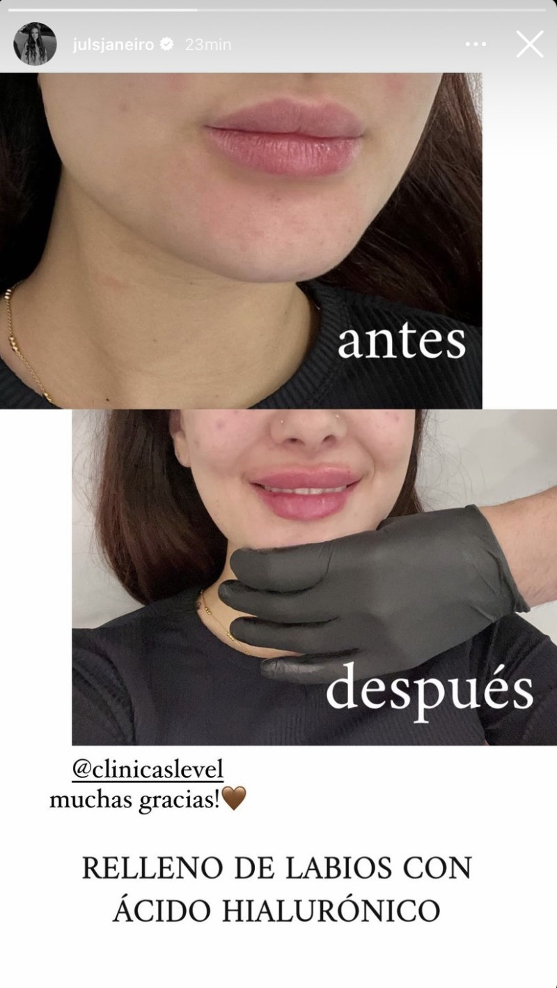 Julia Janeiro muestra su último retoque facial
