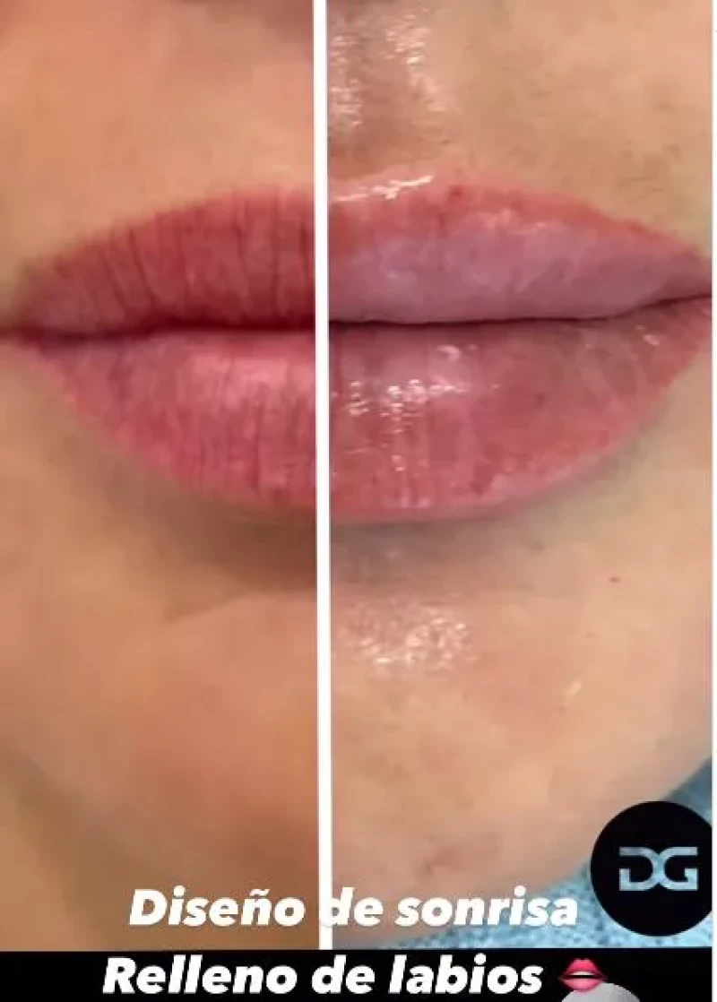 Los labios de Olga Moreno, antes y después del retoque estético.