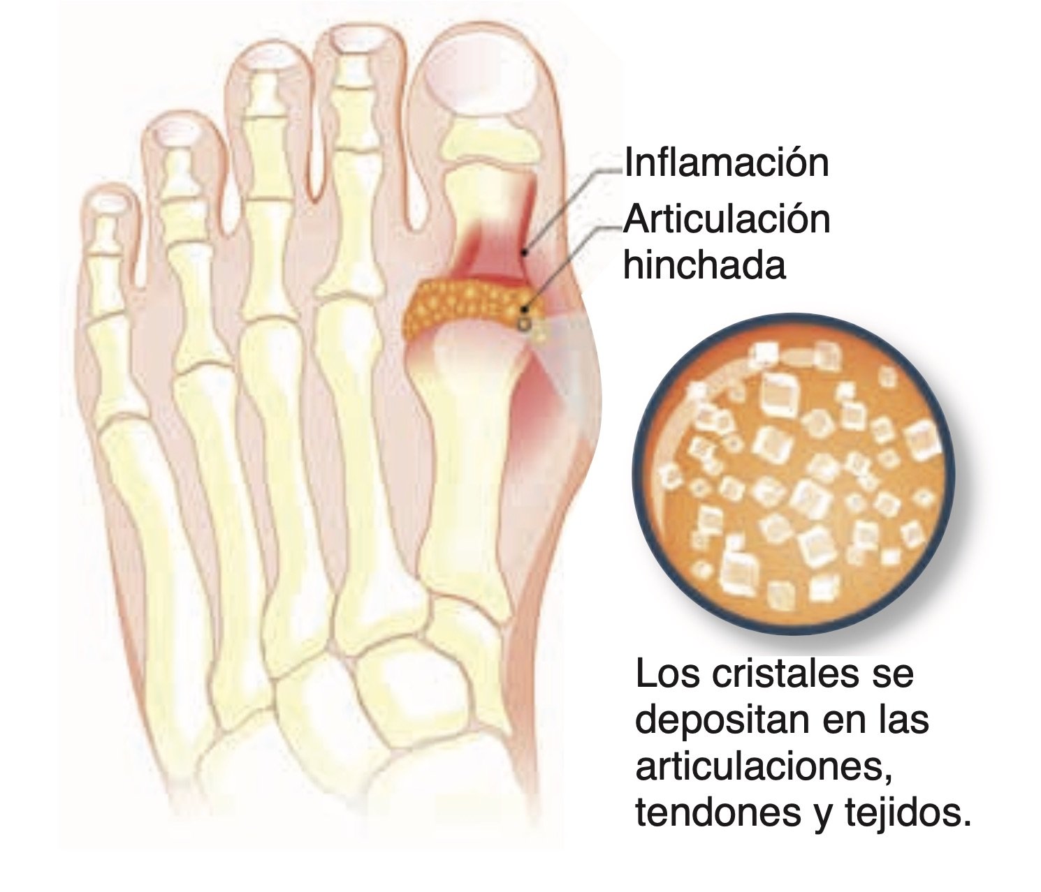 Los ataques de gota. El dedo gordo del pie suele ser la zona más afectada y los cristales acostumbran a deformarlo y limitar su movilidad.