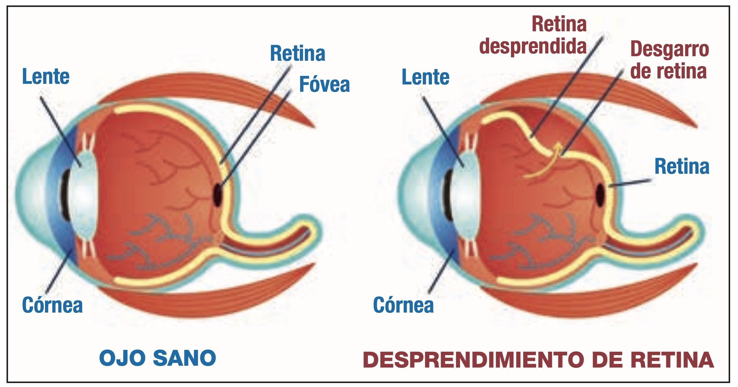 Actuar a tiempo es clave. Ante de producirse el desprendimiento total, la retina se desgarra y se separa de la pared ocular, algo que puede revertirse si se actúa con rapidez.