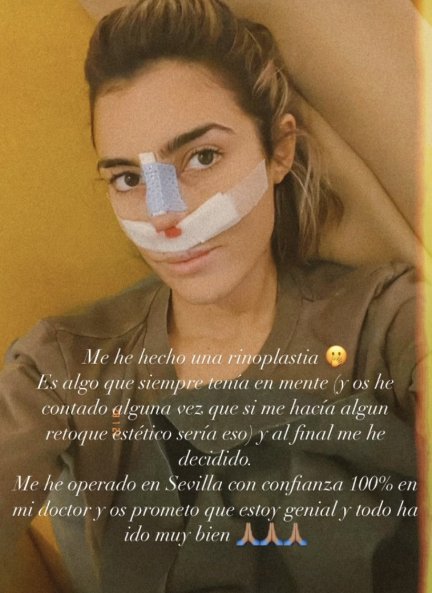 Anna Ferrer tras su rinoplastia (@annafpadilla).