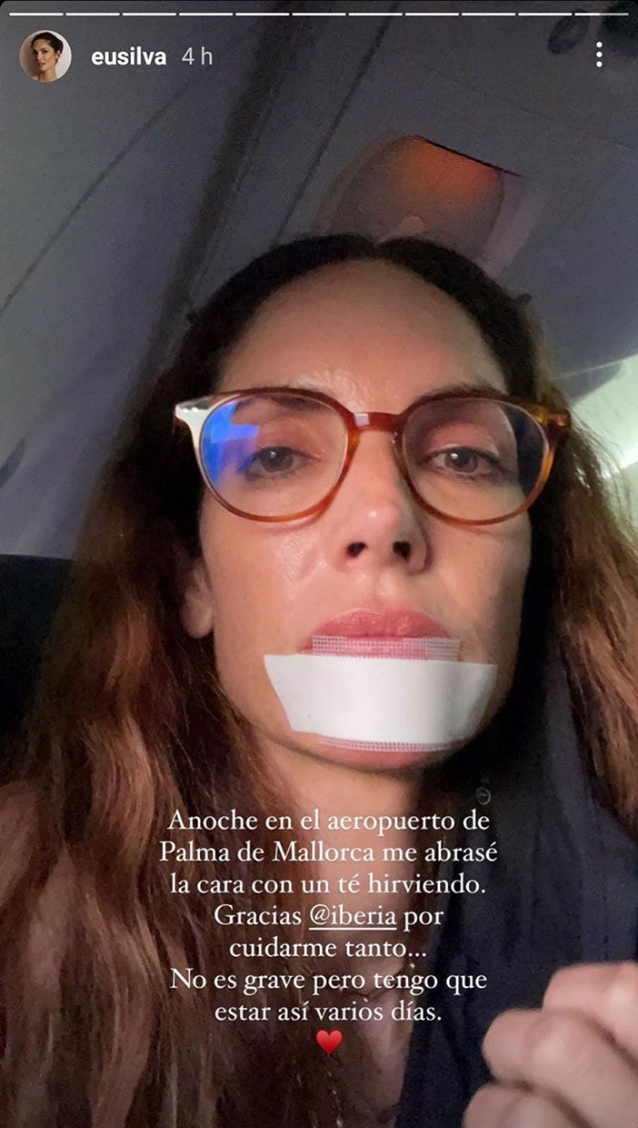 Eugenia Silva justo después de su accidente. (Instagram: @eusilva)