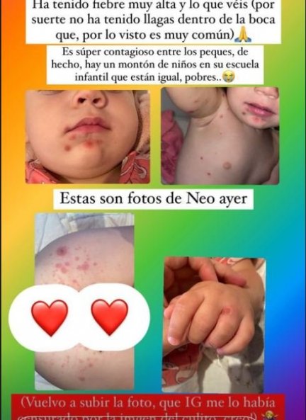 El bebé de Natalia Sánchez sufre boca-mano-pie.