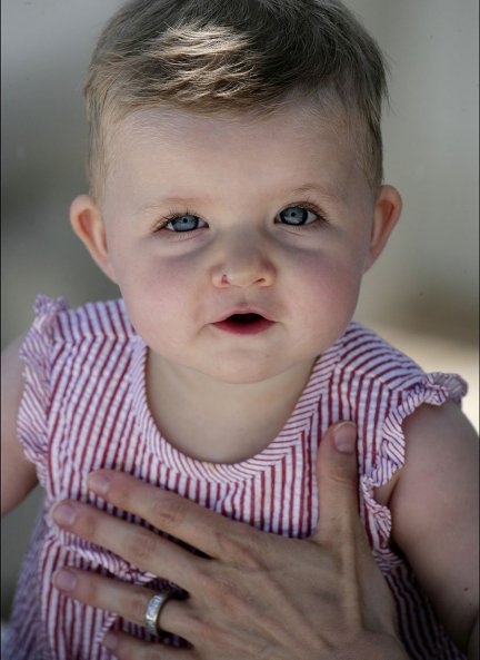 Leonor nació por cesárea y tenía un pequeño angioma.