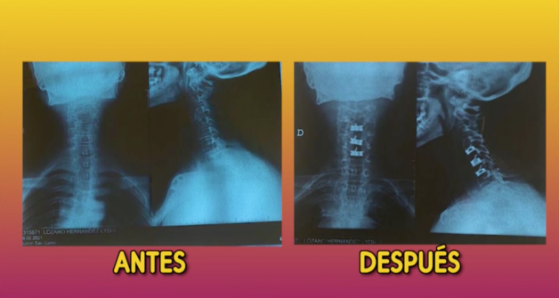 radiografi-as-antes-y-despues-operacio-n-cervicales-lydia-lozano_8_628x335