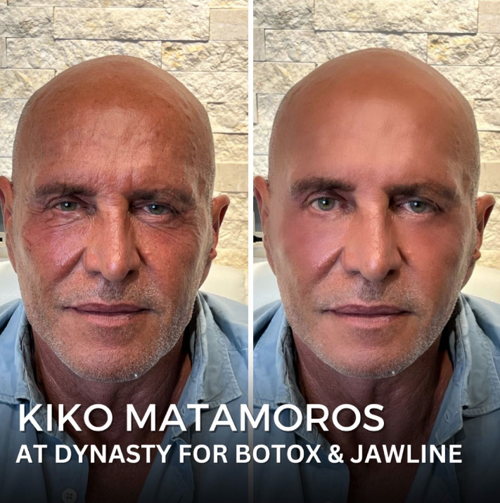 kiko matamoros último retoque estético 1
