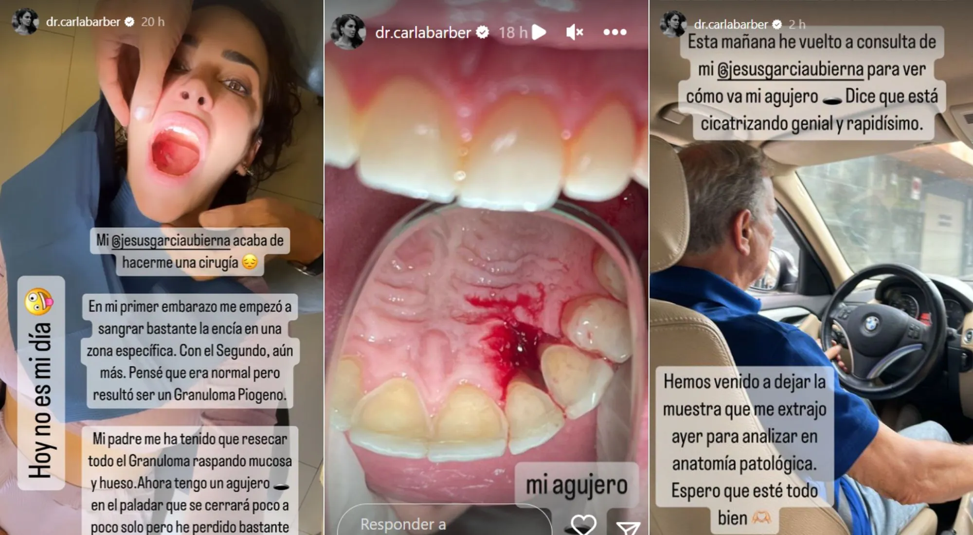 Carla Barber ha mostrado el resultado de su última intervención quirúrgica (Instagram)