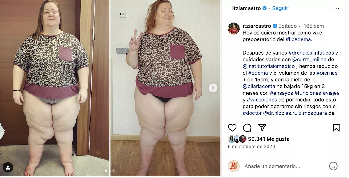 Itziar Castro descubrió gracias a Twitter que sufría lipedema