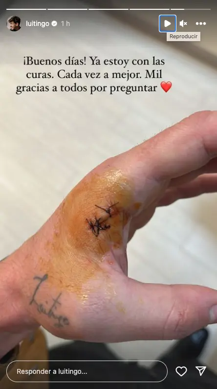 Luitingo comparte una foto de su mano con puntos