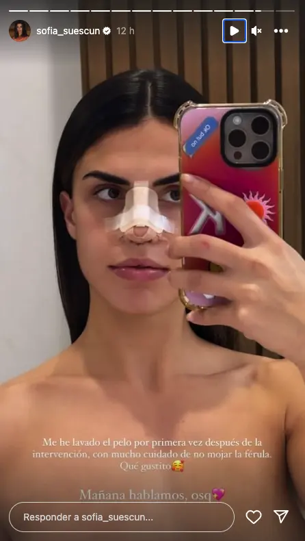 Sofía Suescun con vendaje en stories tras su rinoplastia