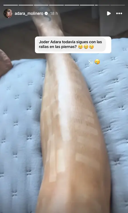 Adara Molinero muestra el estado de las quemaduras de sus piernas.