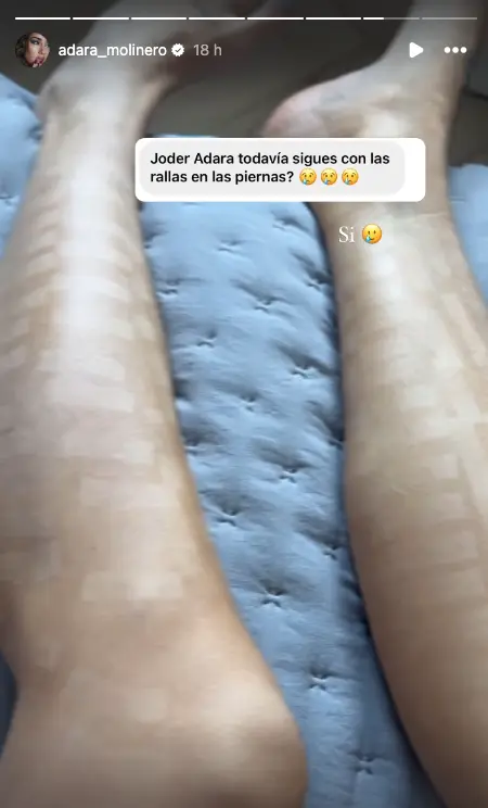 Adara Molinero muestra el estado de las quemaduras de sus piernas.