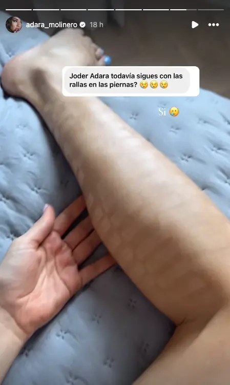 Adara Molinero muestra el estado de las quemaduras de sus piernas.