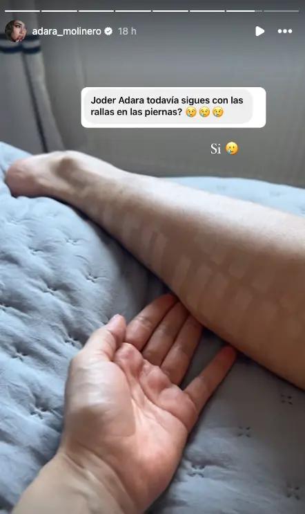 Adara Molinero muestra el estado de las quemaduras de sus piernas.