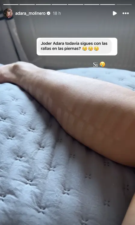Adara Molinero muestra el estado de las quemaduras de sus piernas.
