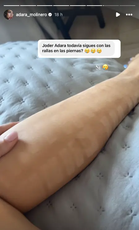 Adara Molinero muestra el estado de las quemaduras de sus piernas.