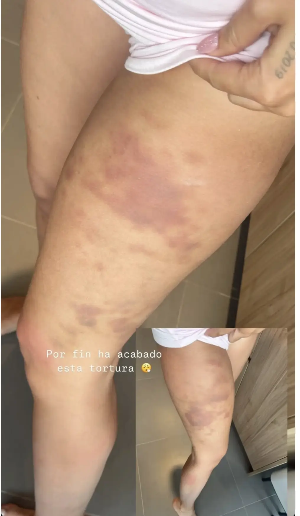 Este es el preocupante estado de las piernas de Laura Escanes.