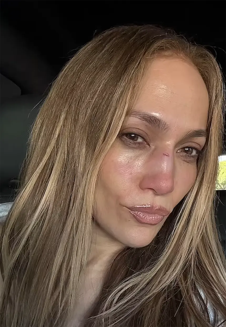 Jennifer López con la nariz rota.