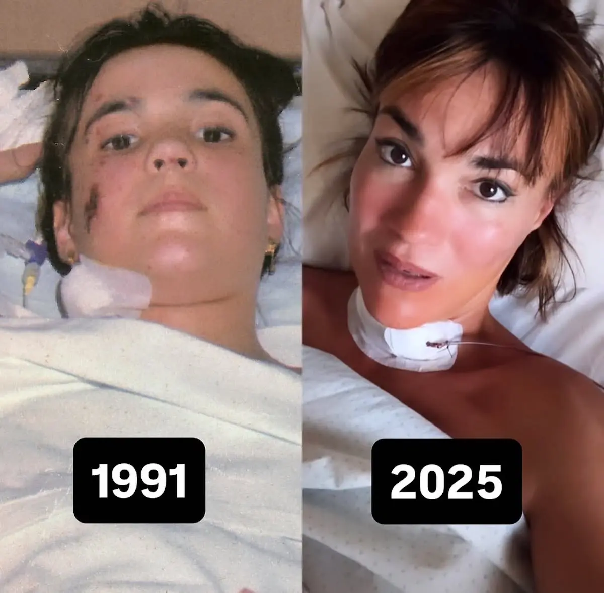 Irene Villa 17 años de la primera operación