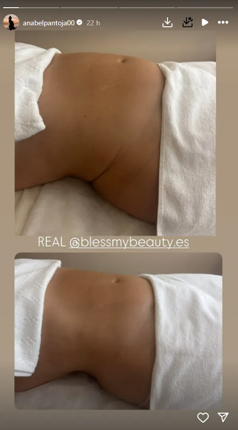 Anabel Pantoja impacta con su gran cambio físico tras un retoque estético: mira las fotos