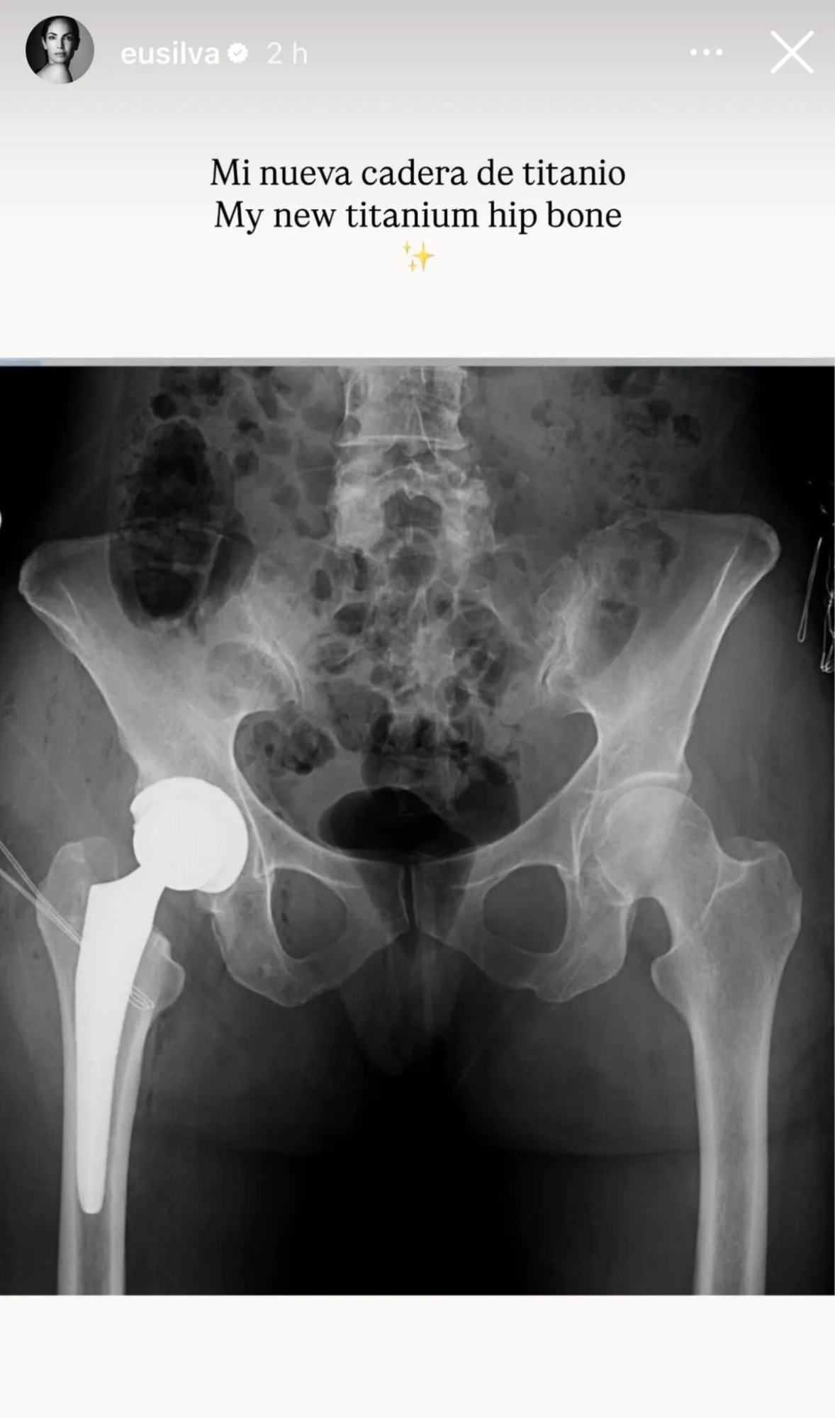 Una radiografía de la pelvis de Eugenia Silva compartida en sus redes sociales