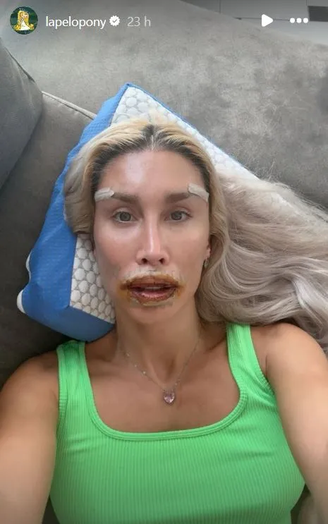 La Pelopony con los labios cosidos tras operarse.