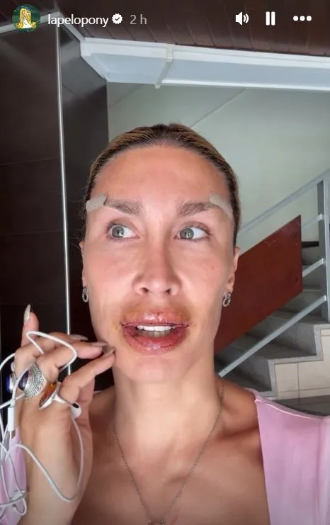 La Pelopony con los labios cosidos tras operarse.