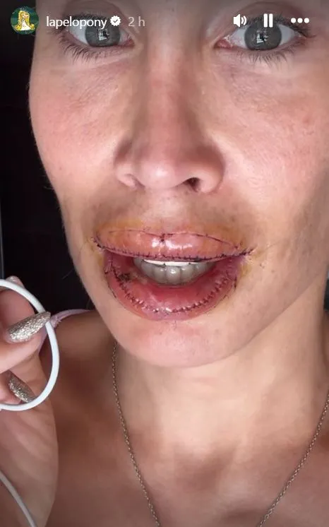 La Pelopony con los labios cosidos tras operarse.