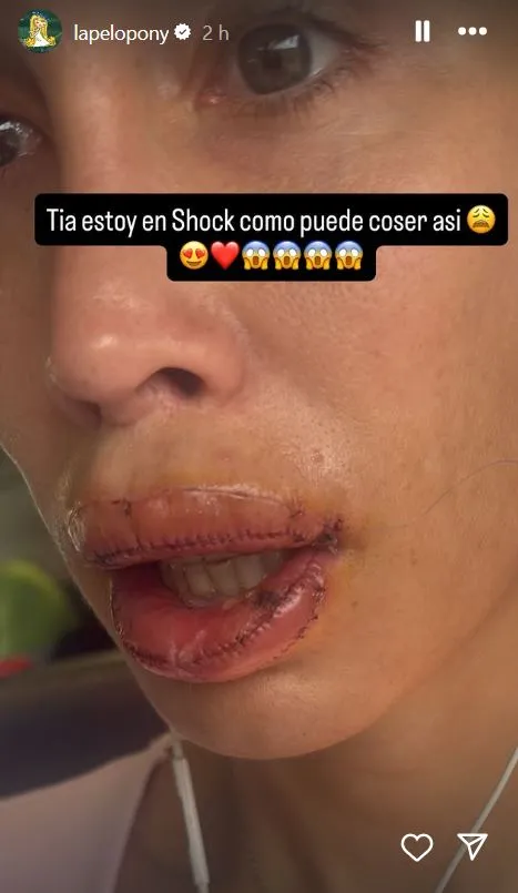 La Pelopony con los labios cosidos tras operarse.